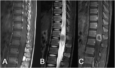 Magnetic Resonance Imaging Findings of Intraspinal Tuberculoma in Children